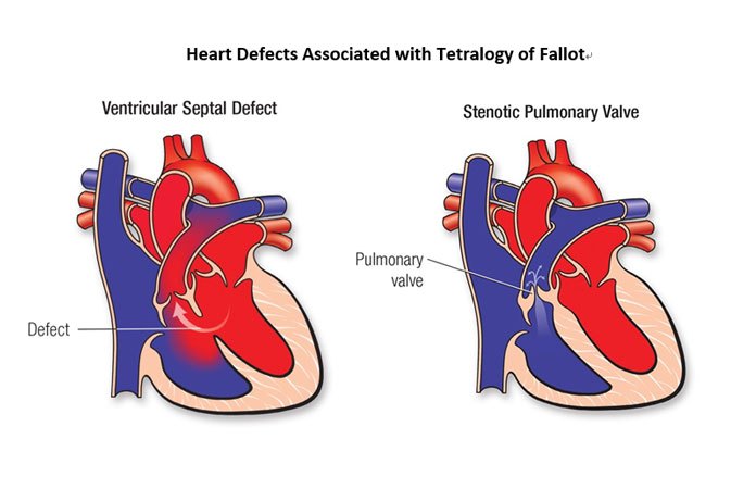 What is Tetralogy of Fallot | New Life Ticket - Part 3