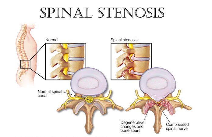 What Causes Spinal Stenosis Page 2 New Life Ticket