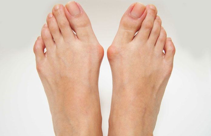 What is Bunion 10 Facts to Know New Life Ticket