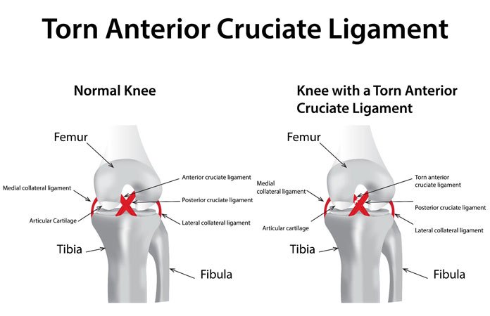 Anterior Cruciate Ligament Acl Tear Injury Causes My Xxx Hot Girl