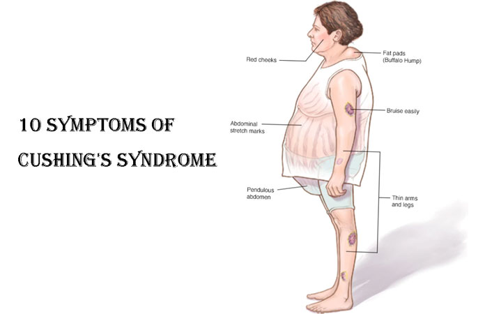 10 Symptoms of Cushing s Syndrome Hypercortisolism New Life Ticket