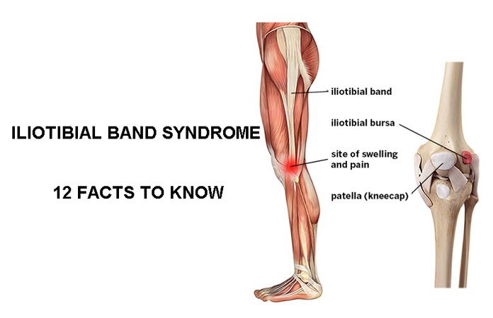 Iliotibial (it) Band Syndrome – 12 Facts To Know – New Life Ticket