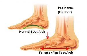 Flatfoot (Pes Planus) – Facts to Know – New Life Ticket