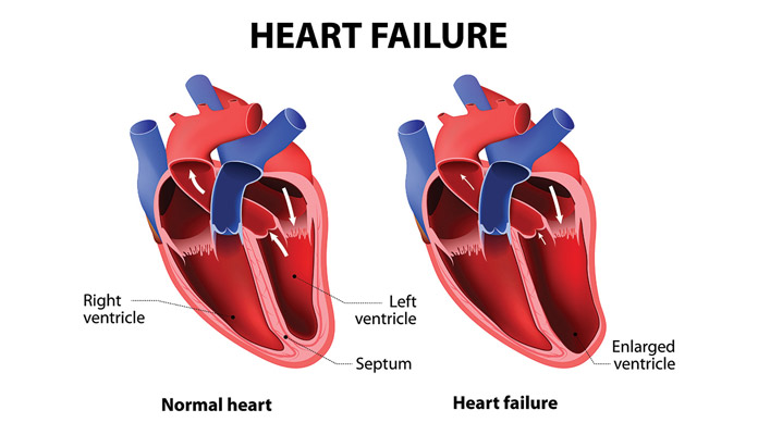 Poverty Associated With Higher Death Rates Due to Heart Failure | New ...