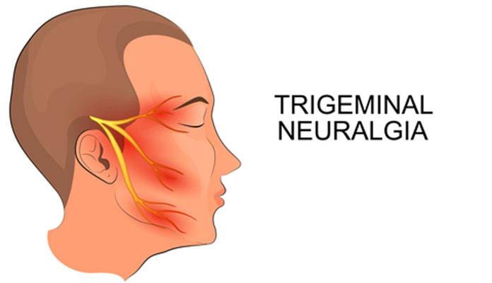 trigeminal-neuralgia-causes-symptoms-and-treatment-page-2-new