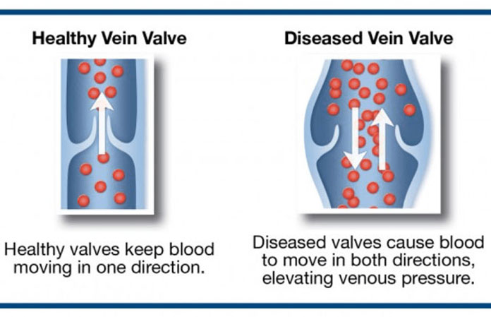 Varicose Veins – Causes, Symptoms & Treatment – Page 2 – New Life Ticket