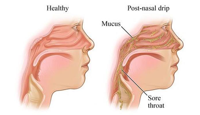 common-causes-of-chronic-cough-new-life-ticket-part-2