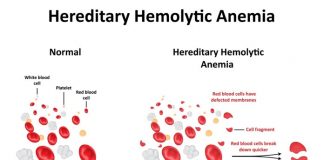 Hemolytic Anemia | New Life Ticket