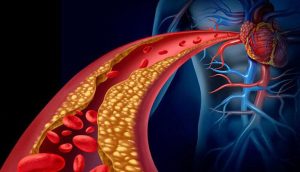 Hypercholesterolemia – Causes, Symptoms, and Treatments – New Life Ticket