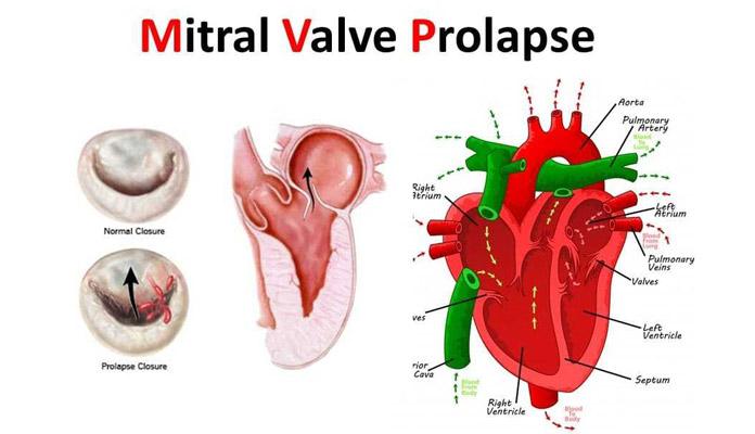 Facts You Need to Know about Mitral Valve Prolapse – Page 2 – New Life ...