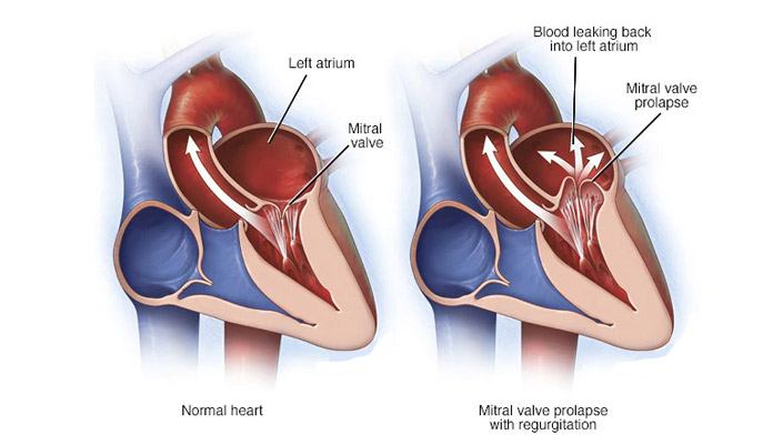 mitral-valve-regurgitation-causes-symptoms-treatment