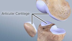 Torn Cartilage in Knee – Facts To Know – New Life Ticket