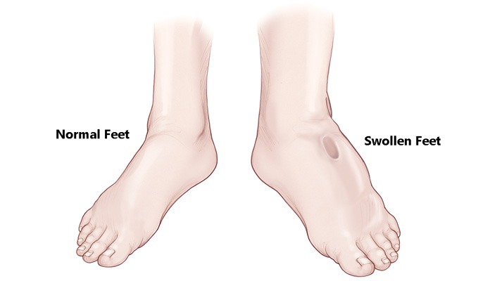 Swollen Feet and Ankles – Symptoms And Causes – New Life Ticket