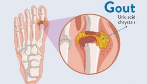 Gout and Diabetes – How Are They Related? | New Life Ticket