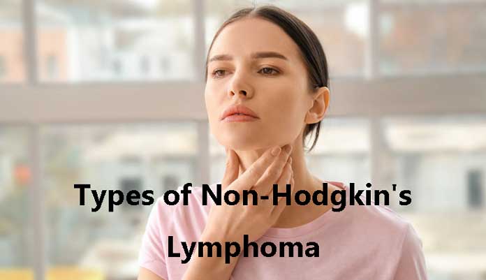 Types of Non-Hodgkin's Lymphoma | New Life Ticket