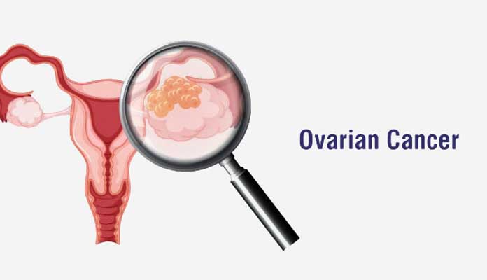 What Test To Diagnose Ovarian Cancer