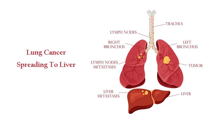 lung-cancer-spreading-to-liver-prognosis-and-more-new-life-ticket